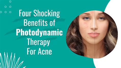 Photodynamic therapy for acne