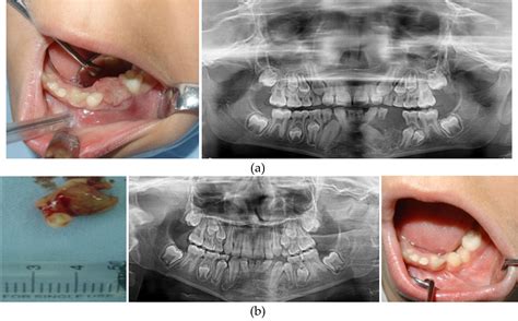 Multidisciplinary Management Of Benign Jaw Tumors In Children Intechopen