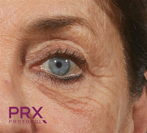 Prx Derm Perfexion Before And After Acqua Blu Medical Spa