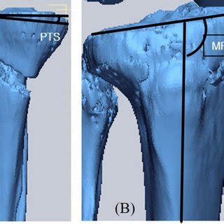 A Posterior Tibial Slope PTS And B Medial Proximal Tibial Angle