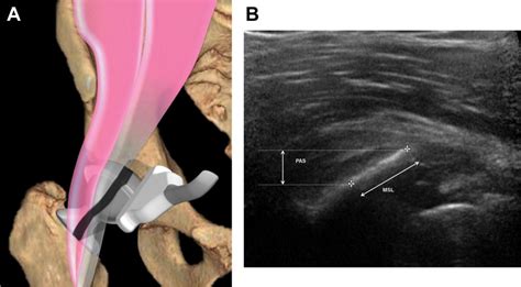 Iliopsoas Bursitis Ultrasound