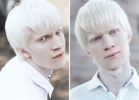 Can Albino People Dye Their Hair