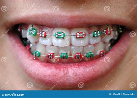 Colorful braces stock photo. Image of brace, dental, orthodonture - 1634602