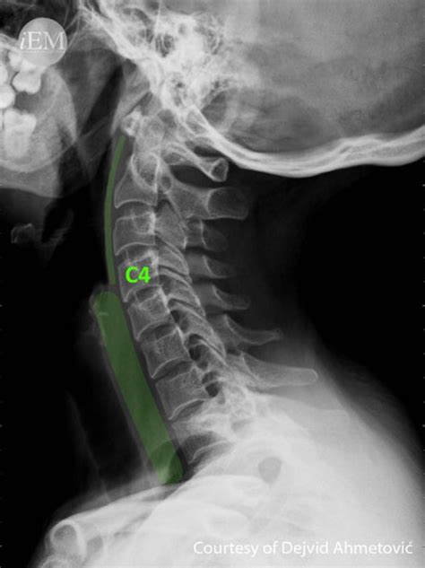 How to Read C-Spine X-Ray – International Emergency Medicine Education ...