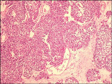 Carcinoma de Celulas Pequeñas Carcinoma de Celulas Pequeñas