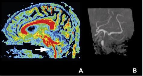 Figure S1 Sagittal Reconstructed Fa Map Derived From Diffusion Tensor