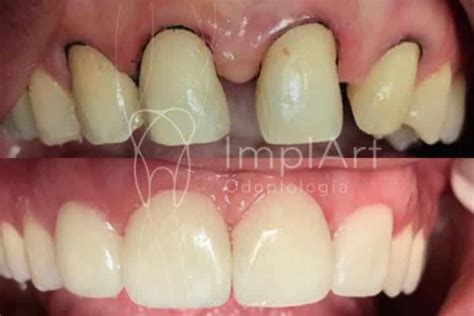 Lente Contato Dental Diastema Antes E Depois 50kb ImplArt