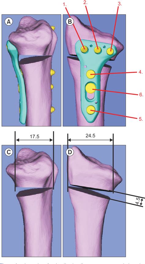 Figure From Open Wedge Osteotomy With Ulnar Shortening For Madelung