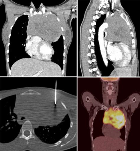 Anterior Mediastinal Mass Radiology At St Vincents University Hospital