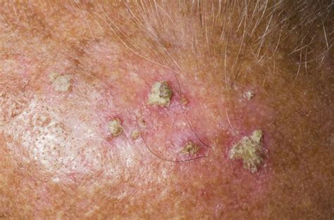 Actinic Keratosis