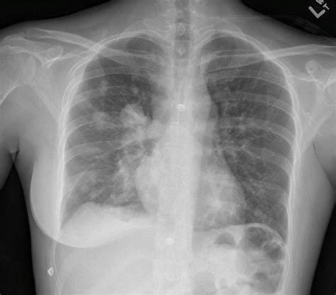 Lung Cancer Pleural Effusion