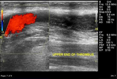 Haemodialysis Upper Limb Arteriovenous Fistula Radiology Reference