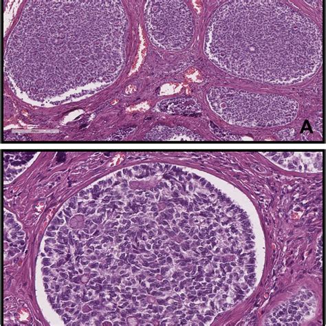 A Inhibin Is Typically Positive In Sex Cord Tumour With Annular