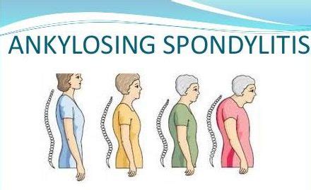 Ankylosing Spondylitis Treatment