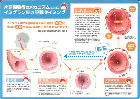 頭痛：①緊張型 ②片頭痛 ③群発頭痛｜株式会社朝陽薬局（公式ホームページ）