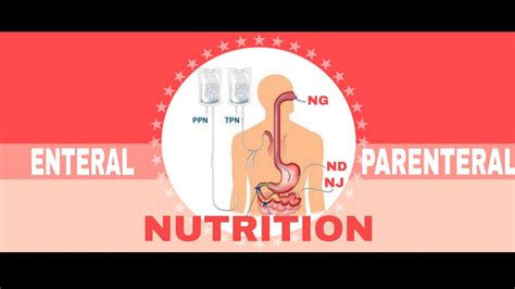 NUTRITIONAL SUPPORT | ENTERAL & PARENTERAL NUTRITION (2/2) - YouTube