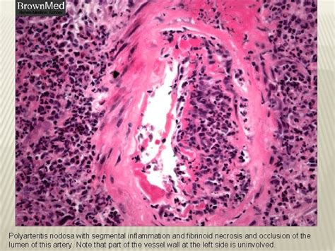 Vasculitis Sufia Husain Pathology Department Ksu Riyadh April