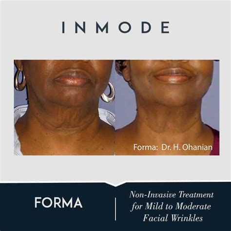 Forma Facial Skin Tightening Chicago Aesthetics Medspa