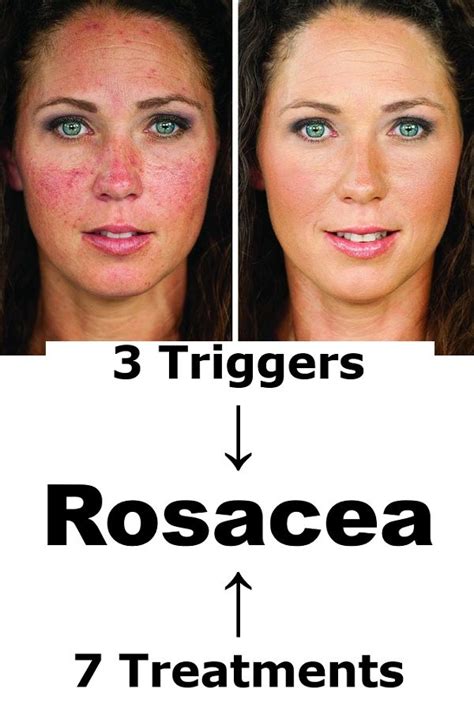 Rosacea → 3 Triggers And 7 Natural Treatments At Home