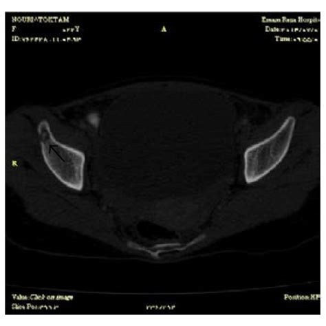 Computed Tomography Scan Shows Multiple Small Osteolytic Lesions Download Scientific Diagram