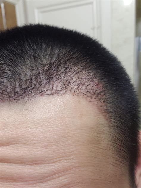 Motion Clinic 1400 Grafts - Re-report and Review : r/HairTransplants