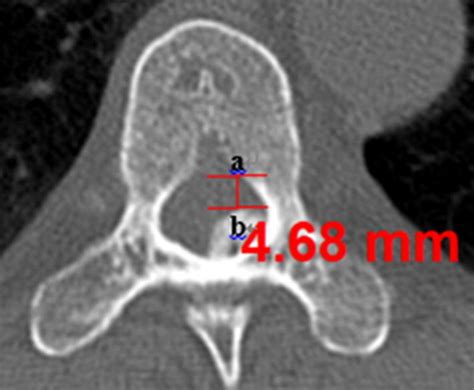 Measurement Of The Anteroposterior Canal Diameter Apd Ab Indicate