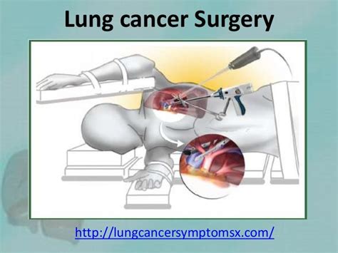 Lung Cancer Surgery