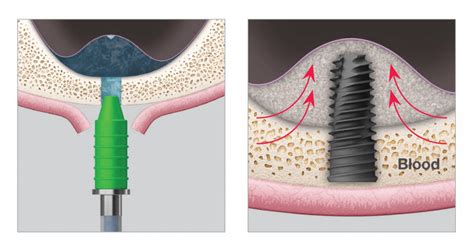 Osstem Implant