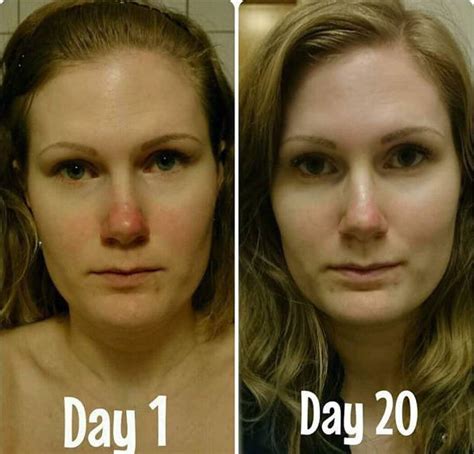 Phymatous Rosacea Natural Treatment » Rhinoplasty: Cost, Pics, Reviews, Q&A