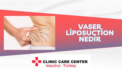 Vaser Liposuction Fiyatlar Ccc Stanbul