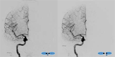 Anterior Choroidal Artery | neuroangio.org