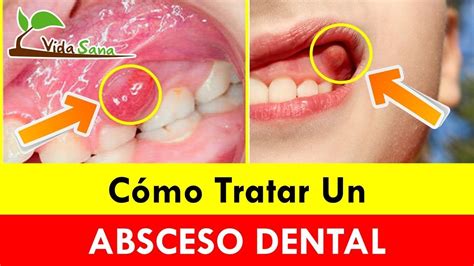 Como Tratar Un Absceso Dental Con Remedios Caseros Antes De Ir Al