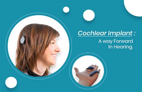 Cochlear Implant A Way Forward In Hearing Asha Speech And Hearing Clinic