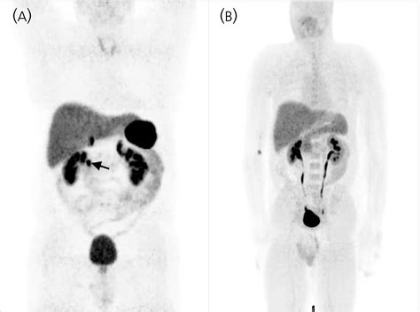 Gadotatocpet Mri And C Htppet Mri Are Superior To Gadotatoc