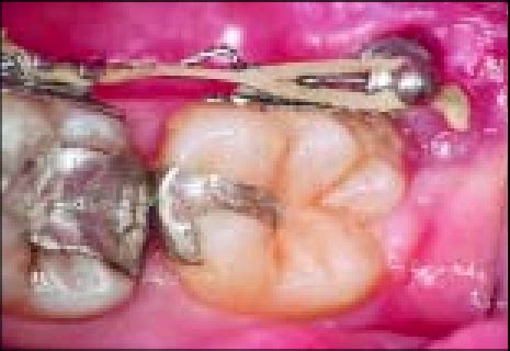 Case From Fig 2 Shows The Distalization Of The Mandibular First Molar