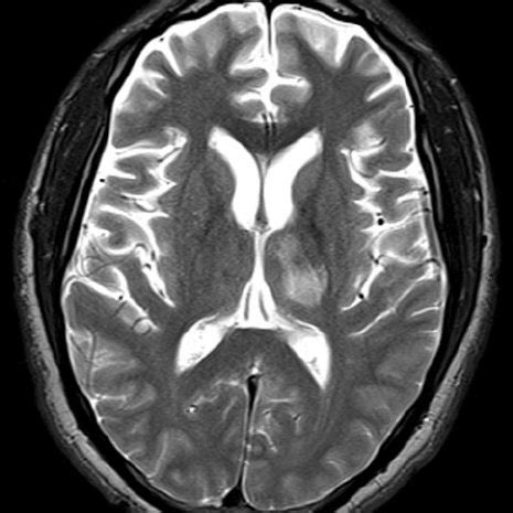 T2 Weighted MR Image Shows A Nonenhancing Hyperintense Focus