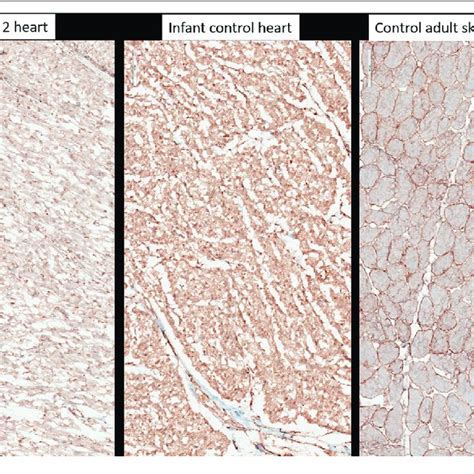 Immunohistochemistry With Anti Alpha Dystroglycan Clone Via4 1