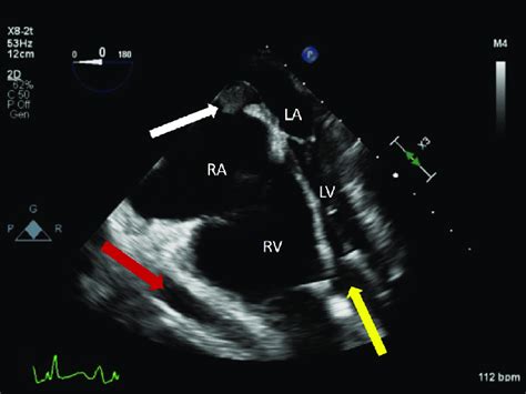 Two Dimensional TEE Midesophageal 4 Chamber View 0 Systolic Phase