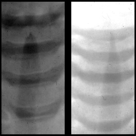 Croup Pediatric Radiology Reference Article Pediatric Imaging Pedsimaging