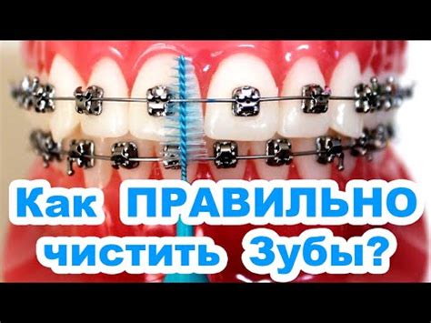 Как Ухаживать за Брекетами?🔴 Как Чистить Зубы с Брекетами? — Советы ...