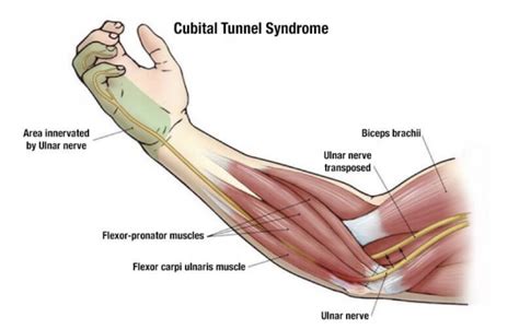 Cubital Tunnel Syndrome - Teton Hand Surgery