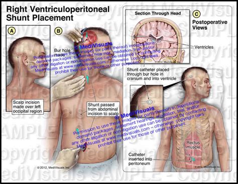 Right Ventriculoperitoneal Shunt Placement Medivisuals Inc