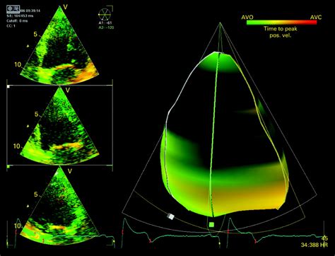 Technological Advances In Tissue Doppler Imaging Echocardiography Heart