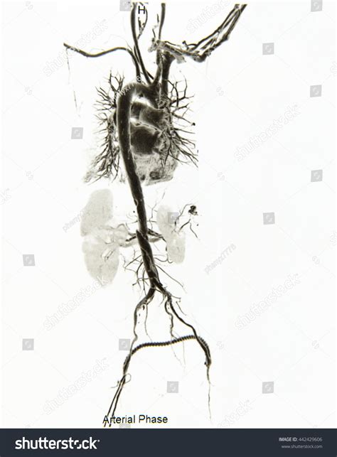 Film Ct Scan Angiography Take Photo Stock Photo (Edit Now) 442429606 ...