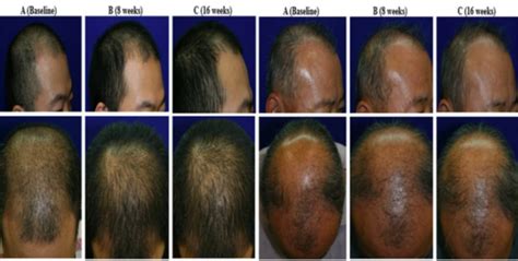 Baldness Cure Possible With Stem Cell Topical Solution Wig Allure