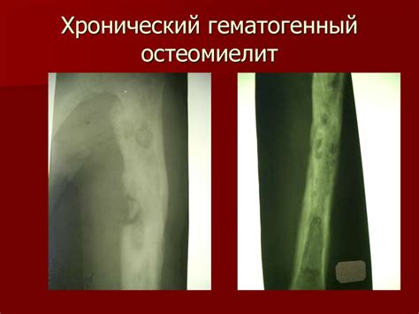 Остеомиелит. Классификация остеомиелита. Лечение - online presentation