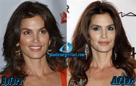 Cindy Crawford Plastic Surgery Before and After Photos