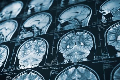 Why You Can’t Rely on a CT Scan or MRI to Diagnose a Traumatic Brain ...