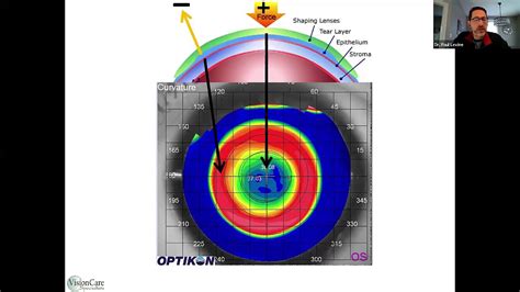 Orthokeratology Troubleshooting Patient Cases Youtube