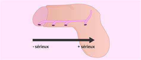 Qu Est Ce Que L Hypospadias Et Comment Cela Affecte T Il L Ducation